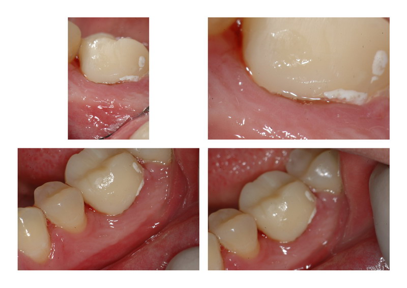 Osseous Recontouring MB pg 1.jpg